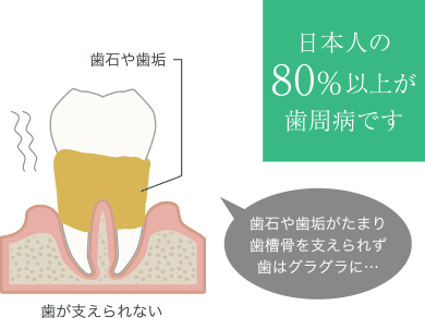 日本人の80%以上が歯周病です 歯石や歯垢がたまり歯槽骨を支えられず歯はグラグラに…